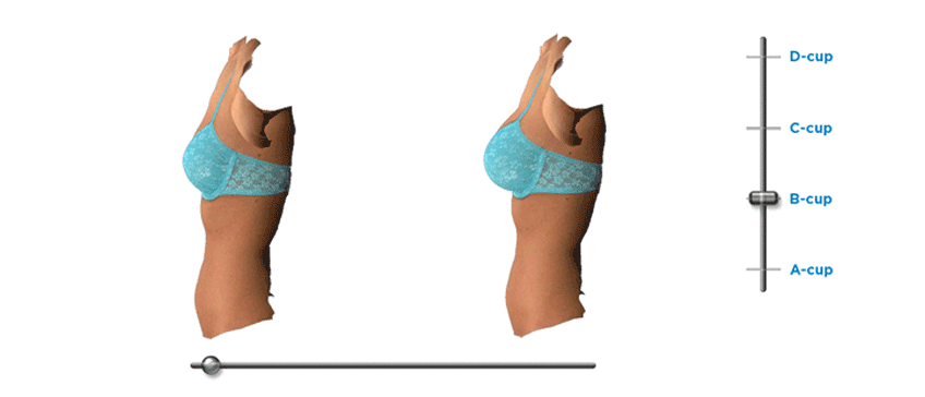 BREAST AUGMENTATION